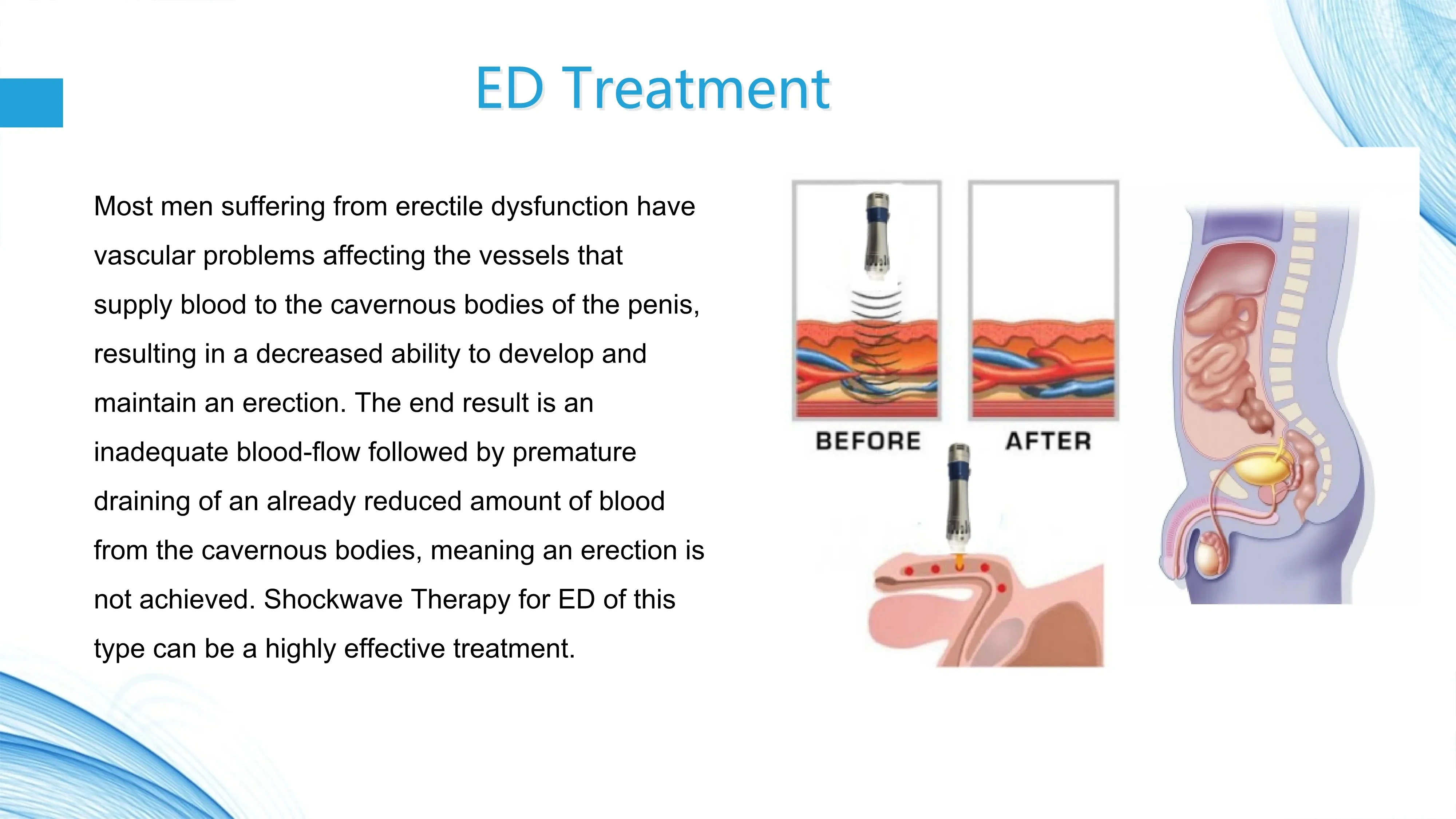Innovative Products Effective Physiotherapy Equipment Radial Focused ED Pain Relief Shockwave Therapy Machine ESWT