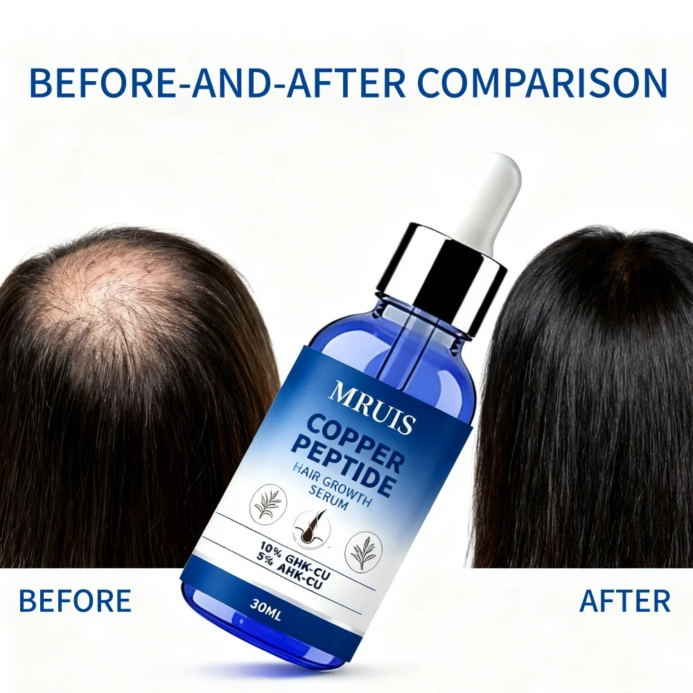 ghk cu hairline Oem Odm Ghk-cu Ahk-cu Copper Peptide Hair Growth Serum Anti Hair Loss For Receding Nourishing Scalp Serum For Men Women Cu helps with tissue Why Achilles tendon injuries Pack size:1 pouch tuberculin skin test