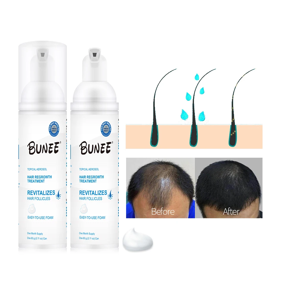 Factory Supply Anti Loss Fast Hair Care Growth Mousse Hair Growth Foam Hair Regrowth Treatment for Men Women