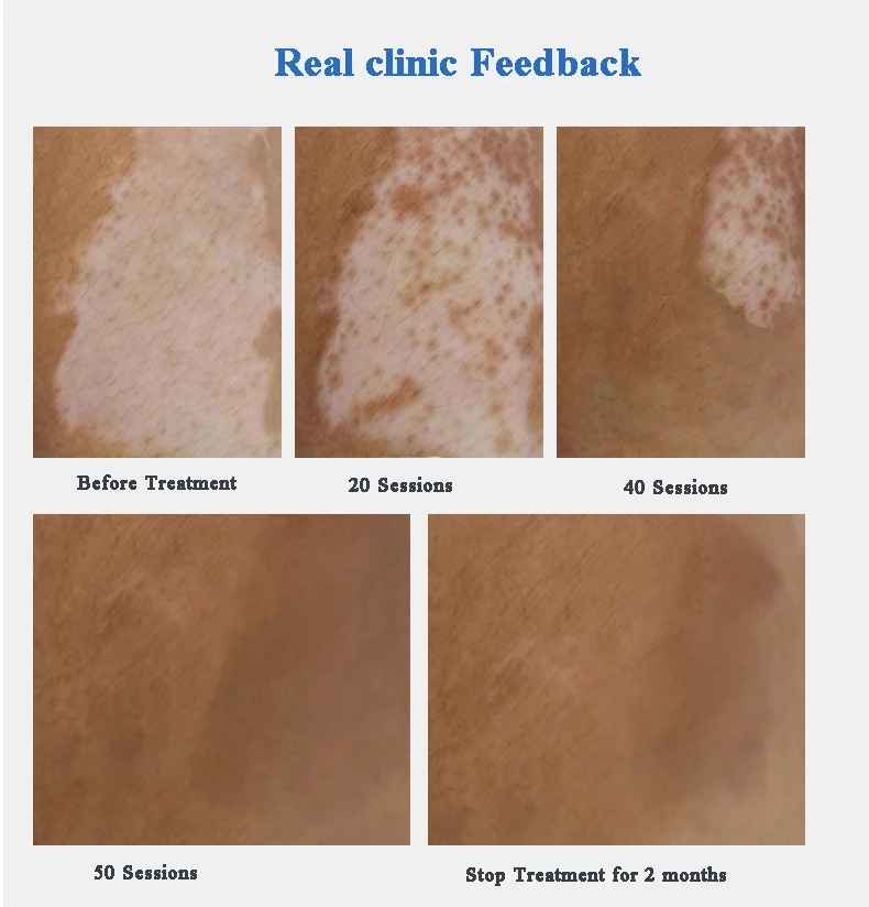 Handheld Uv Home Phototherapy Uvb Light Therapy Uvb Lamp Phototherapy