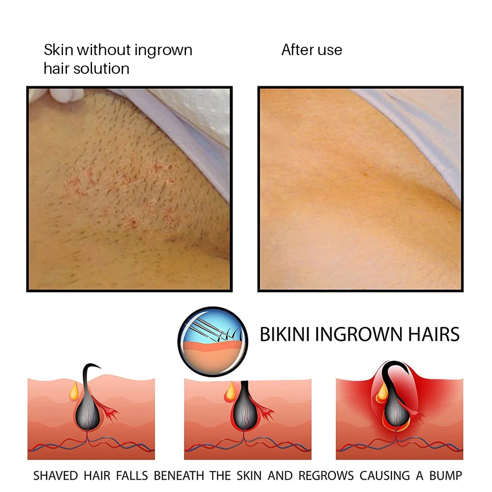100% Natural Formula Remove Dark Spot After Shave Razor Bumps Treatment Solution Ingrown Hair Removal Roll on Ingrown Hair Serum