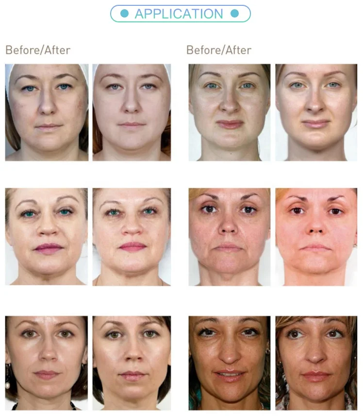 2ml GMP plant cross linked hyaluronic acid filler anti wrinkle injection buy injectable dermal fillers