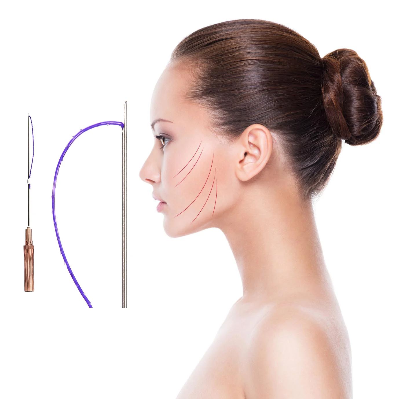 Best Selling Pdo Thread 4d Cog With Sharp Needle L Blunt And W Blunt Type -  Buy Pdo Cog Thread Lifting,Cog Thread Sharp L Blunt W Blunt Type,Face  Lifting Thread Product on