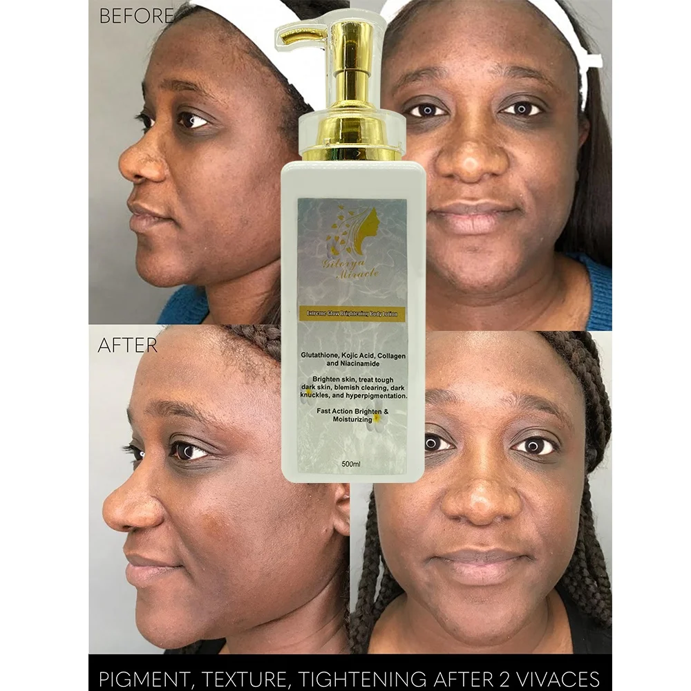 Locin Corporal Aclarante Extreme Glow con Glutatin, cido Kjico y  Colgeno para Aclarar la Piel y Tratar las Manchas Oscuras Persistentes