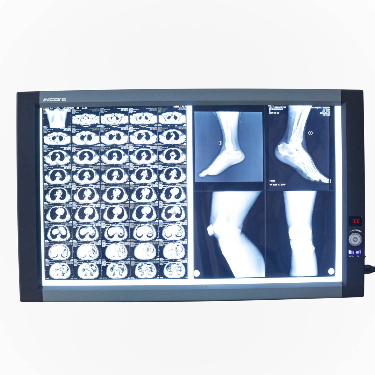 Adjustable Medical X Ray Film Viewer Led Screen Quadruple Negatoscope Led with Sensor