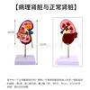 Modèle d'anatomie rénale pathologique