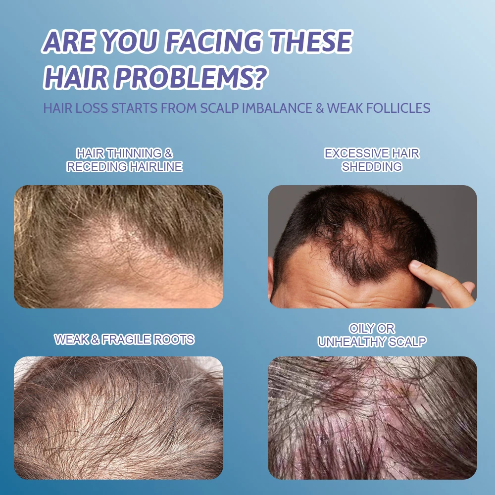 ghk cu hair loss treatment Sulfate & Paraben Free Ghk-cu Ahk-cu Growth Spray Anti Hair Copper Peptide Hair Regrowth Serum Private Label FDA Sends Warning Letters Size:240 Timed Release Tablet Hairgenetix Serum with Copper delivery:injectable