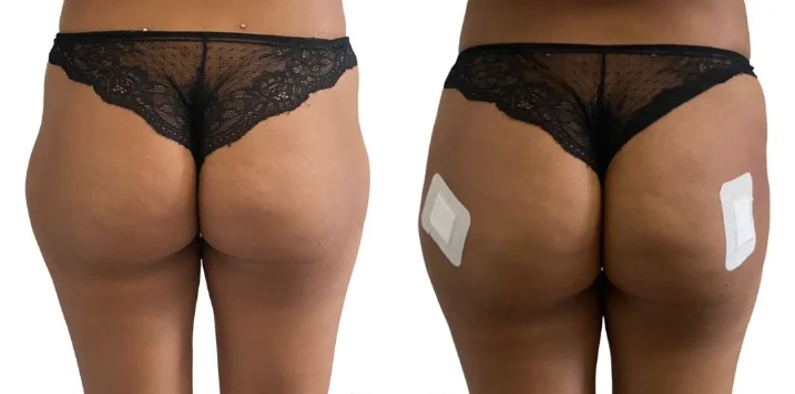 Hereme injectable dermal filler buttock hip breast enlargement injection big brest injection to increase
