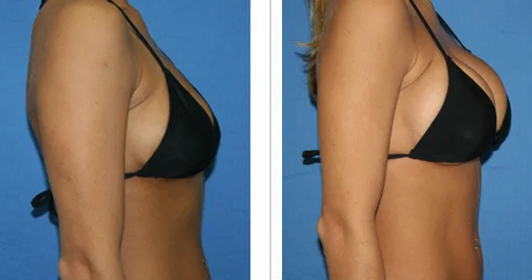 Hereme injectable dermal filler buttock hip breast enlargement injection big brest injection to increase