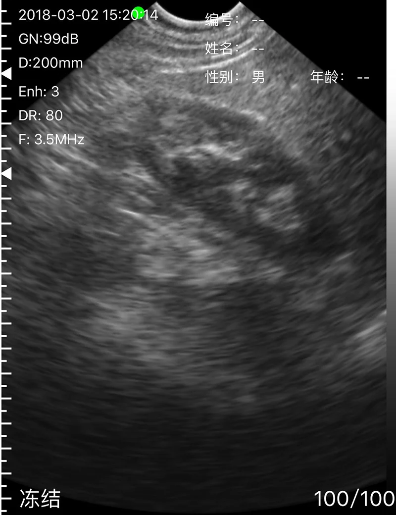 SURESULT D2LM Linear Micro Convex Transductor De Ultrasonido De Matriz Lineal De Alta Frecuencia Color Doppler