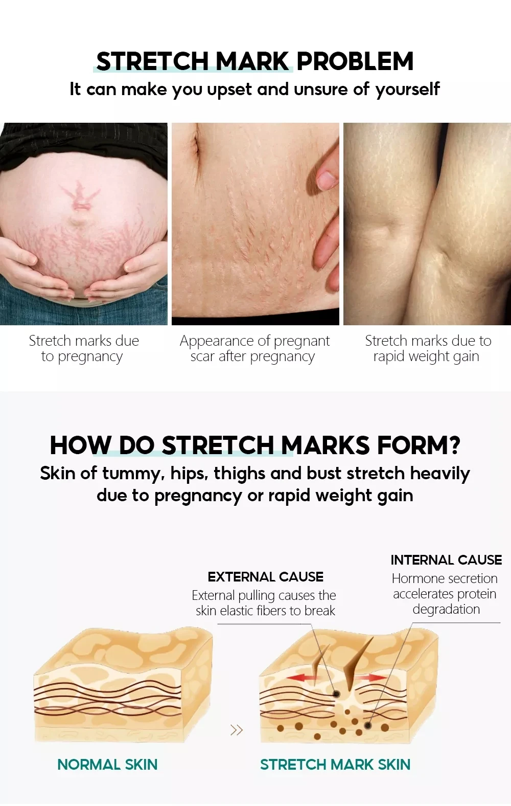 VIBRANT GLAMOUR Pregnancy Treatment Stretch Marks Cream 30g