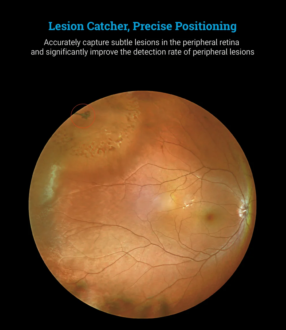 170&deg; Ultra Wide Field Fundus Imaging System Retinal Camera with Four Laser Sources and Automatic Eye Positioning