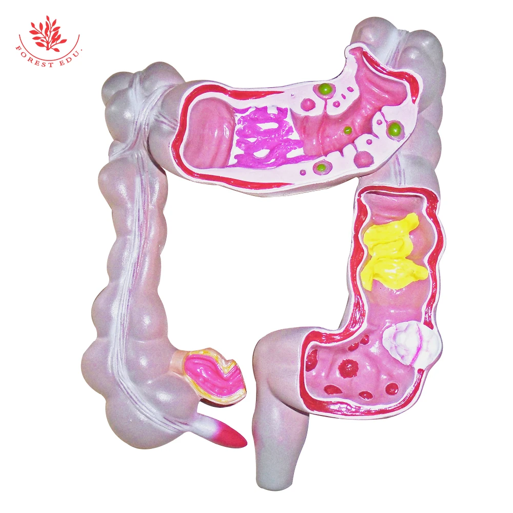 Colon Comprehensive Pathology Model Gastrointestinal System Pathology ...