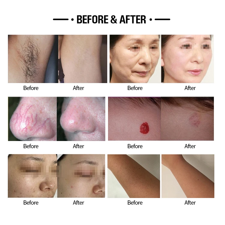 alex laser treatment alex laser treatment