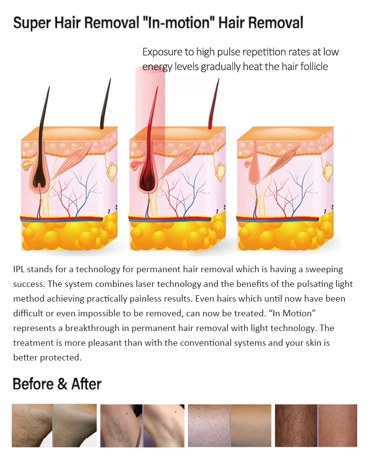 Portable 2 in 1 Q-SWITCH Tattoo Removal Carbon Peeling Skin Whitening Machine/ Fast IPL Hair Removal Machine