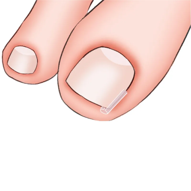 Indrown Nail Type C Pad Plastic Groove Spacer Straightener for Ingrown Nail Inflammation Filling Long Toenail Meat Paste