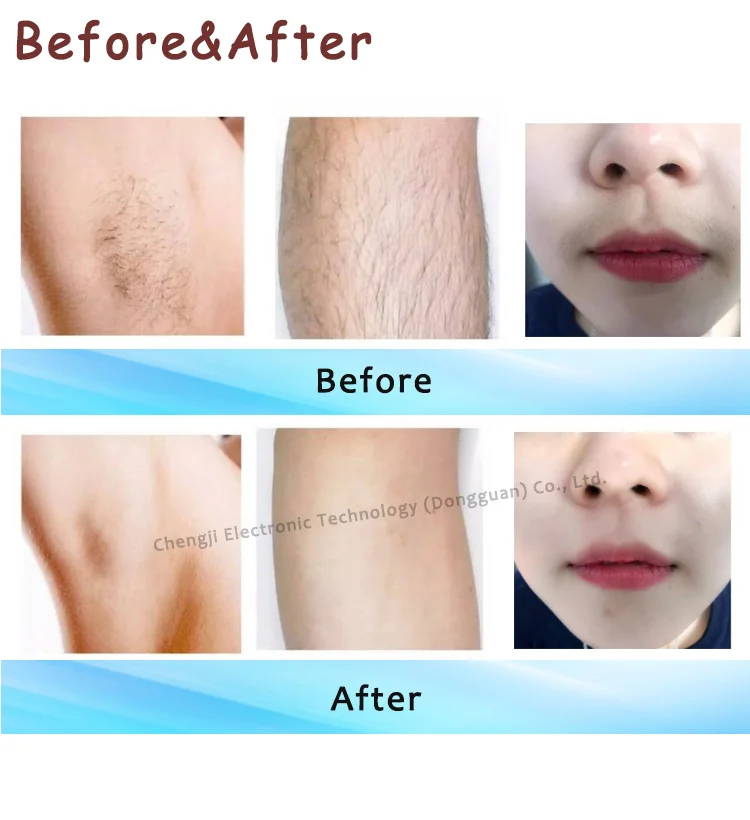 2025 New Multi-Wavelength (755nm/808nm/1064nm) Diode Laser Hair Removal Machine with 16 Language Support and 50 Million Shots