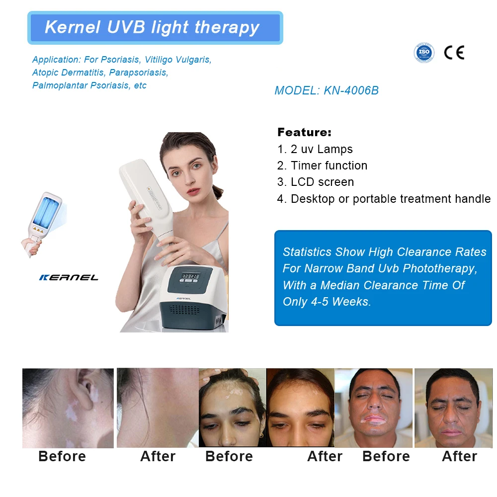 Kernel Medical UVB Vitiligo Treatment Device - 368nm UVA Light Therapy