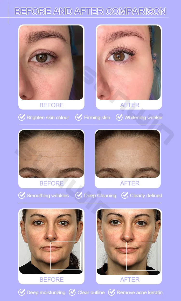 2024 6 in 1 Aqua Peeling Hydro Dermabrasion Machine Skin Cleansing for Clinic Beauty Salon Use
