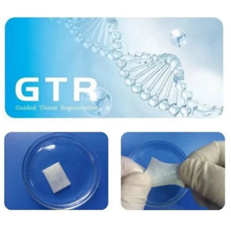 GTR Membrana Reparationis Cavitatis Orales Adultorum Medica Collagena Absorbibilis Biologica Implantatio Dentalis Classis III Cura Orales