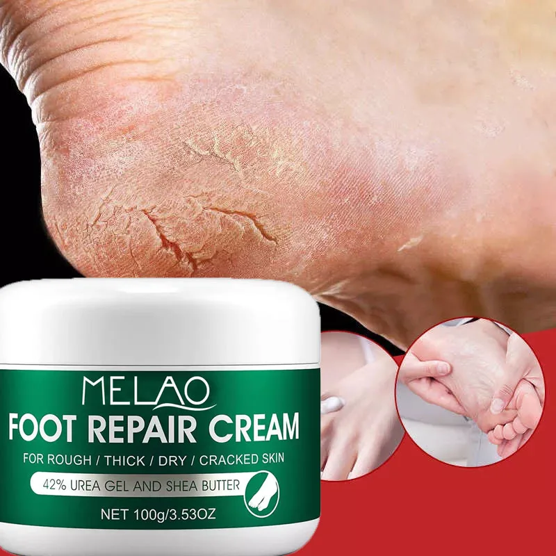 Moisturizing Urea Feet Cream Softens Dry, Cracked Skin