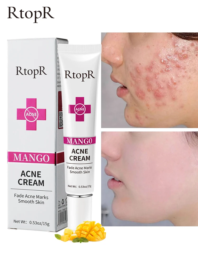 Mango repair acne deals cream