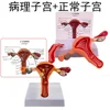 Útero patológico con revestimiento uterino, útero normal