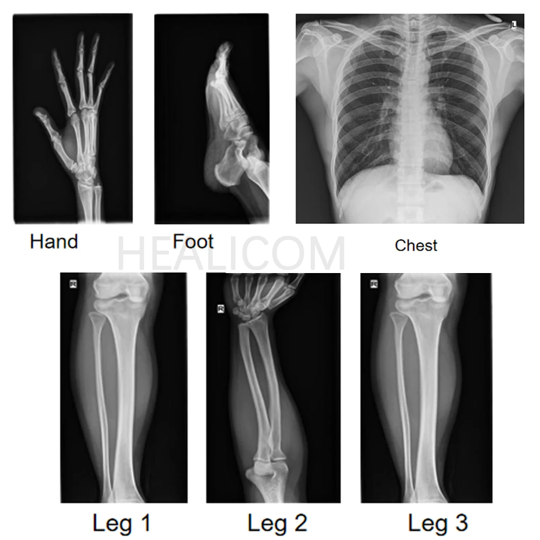 Highest Cost-effective HEALICOM HFX-08D Touch Screen Portable Mobile DR X-ray Machine factory