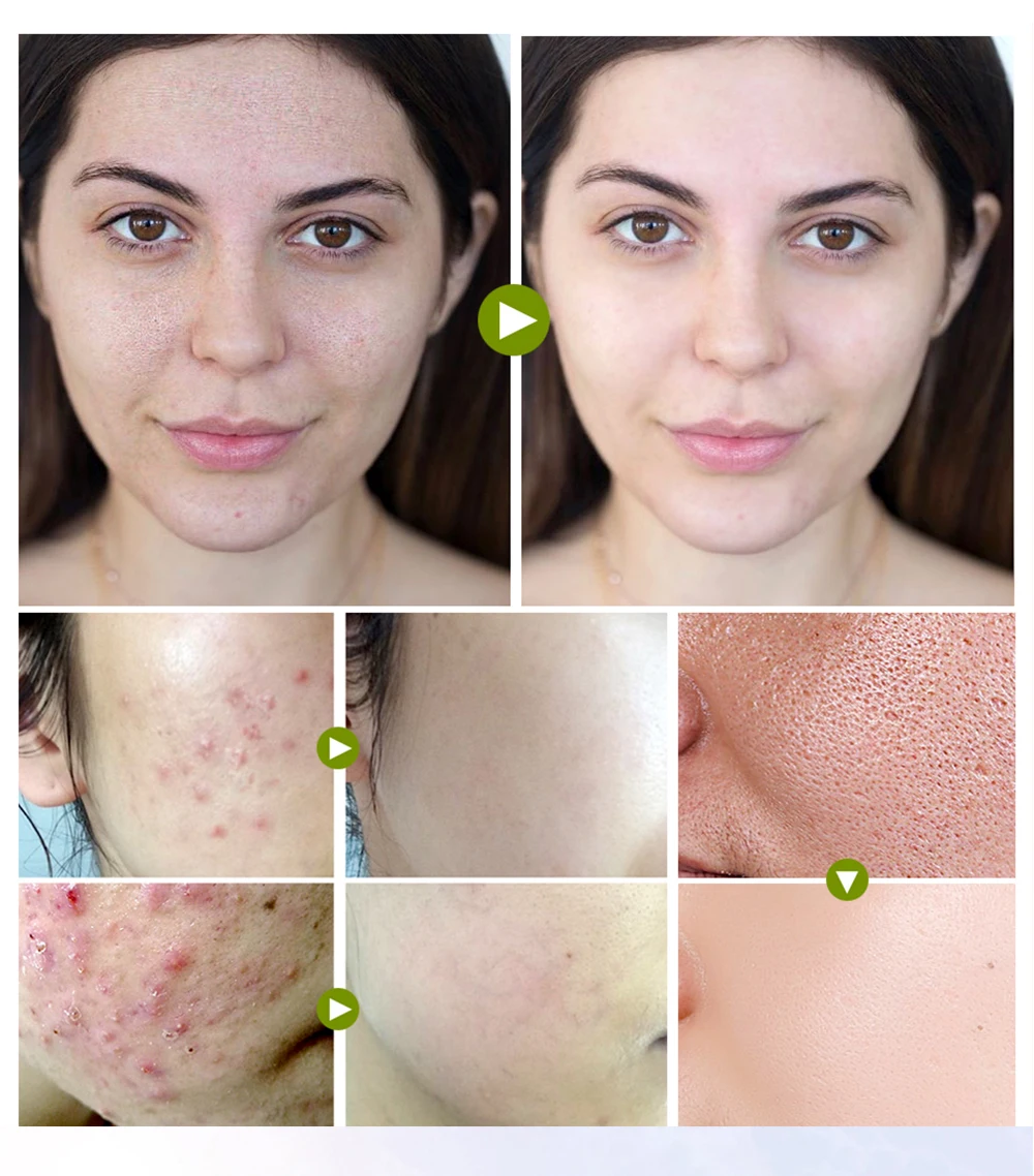 BREYLEE Private Label Tea Tree Oil Dark Spot Removing Acne Pimple Skin Repair Face Cream supplier