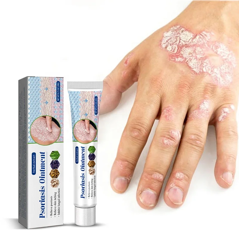 20g Psoriasis Ointment Acne Dermatitis Scrotum Eczema Pityriasis Urticaria Psoriasis Treatment