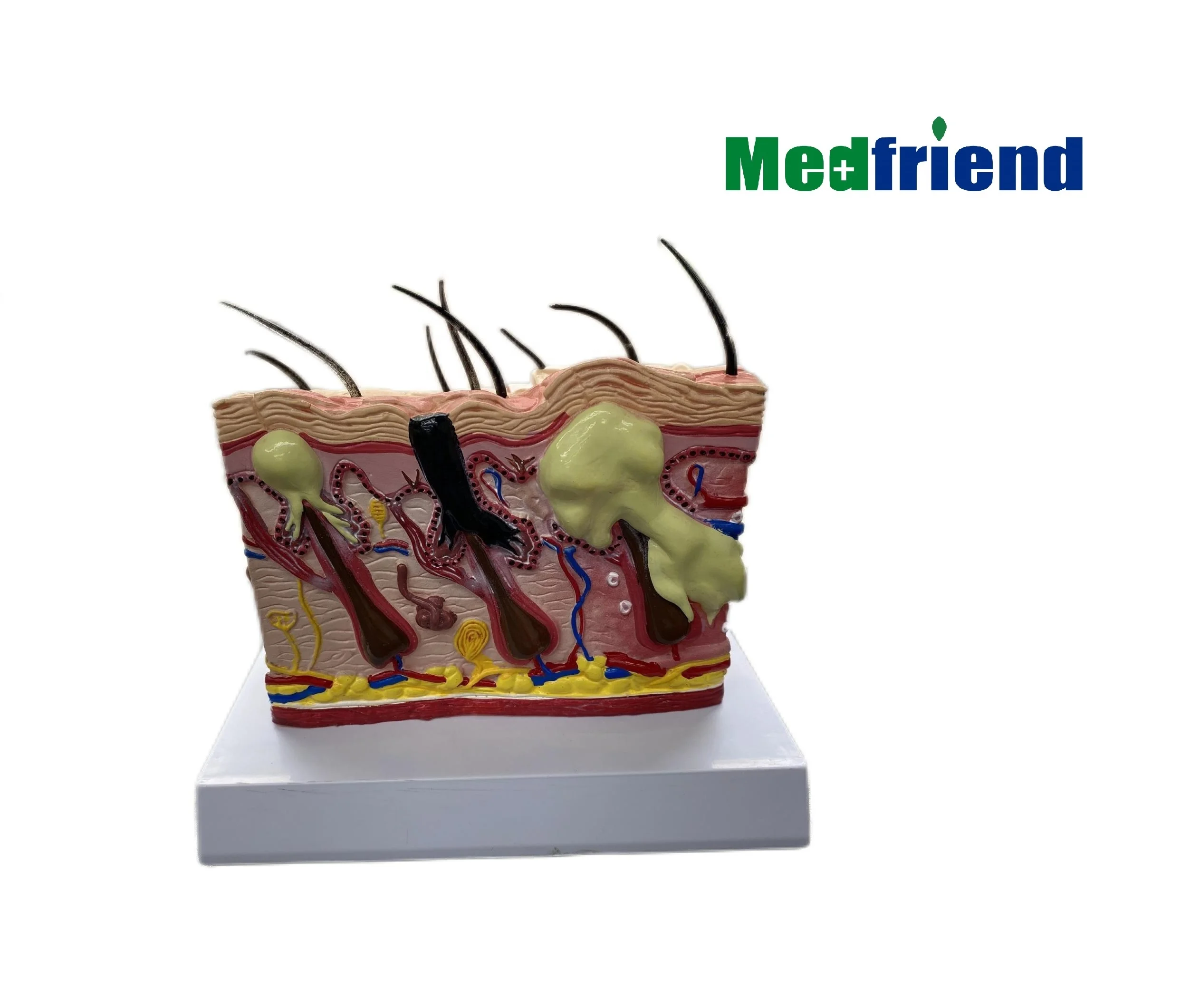 Factory Price Diseased Skin Model of Acne for Teaching| Alibaba.com
