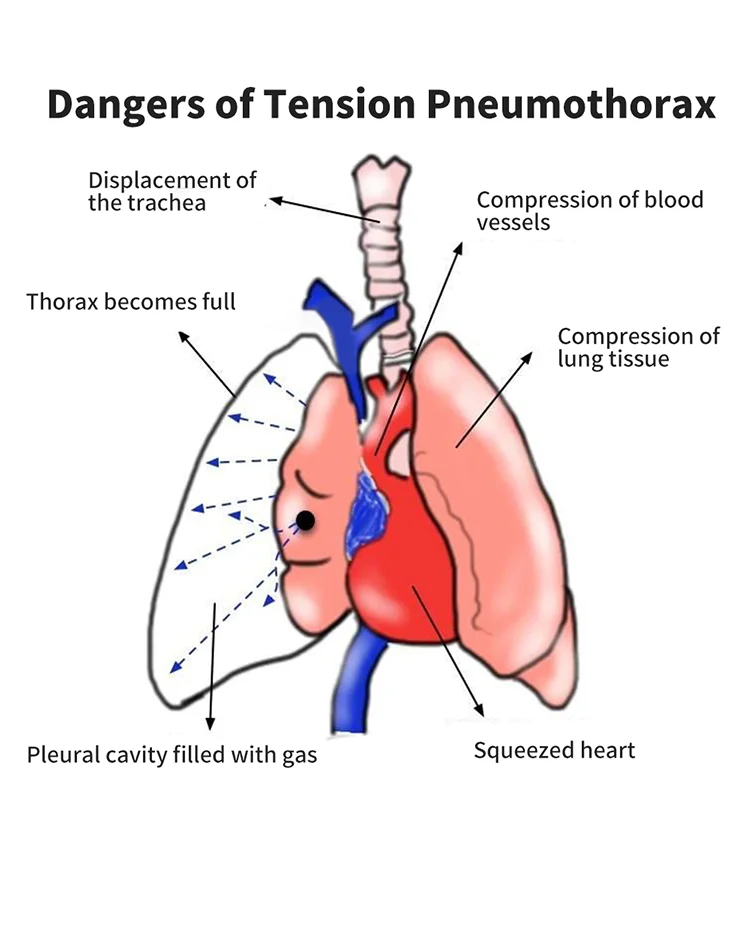 Outdoor Emergency Rescue Pneumothorax Deflation Needle Disposable ...