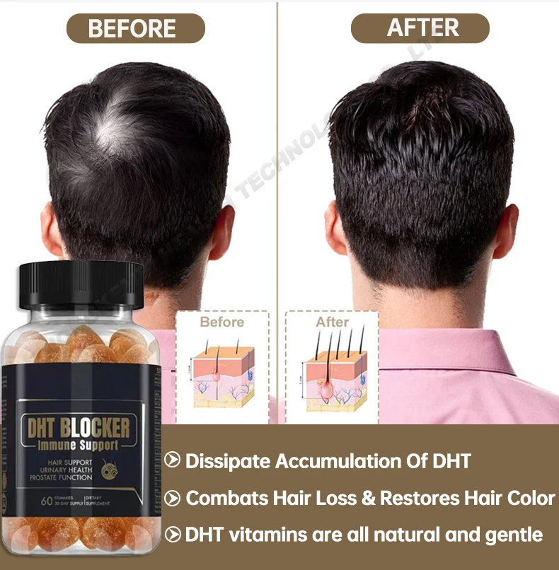 Kirkland Saw Palmetto Dht Blocker Gummies 5 Min Dht Block Thicker