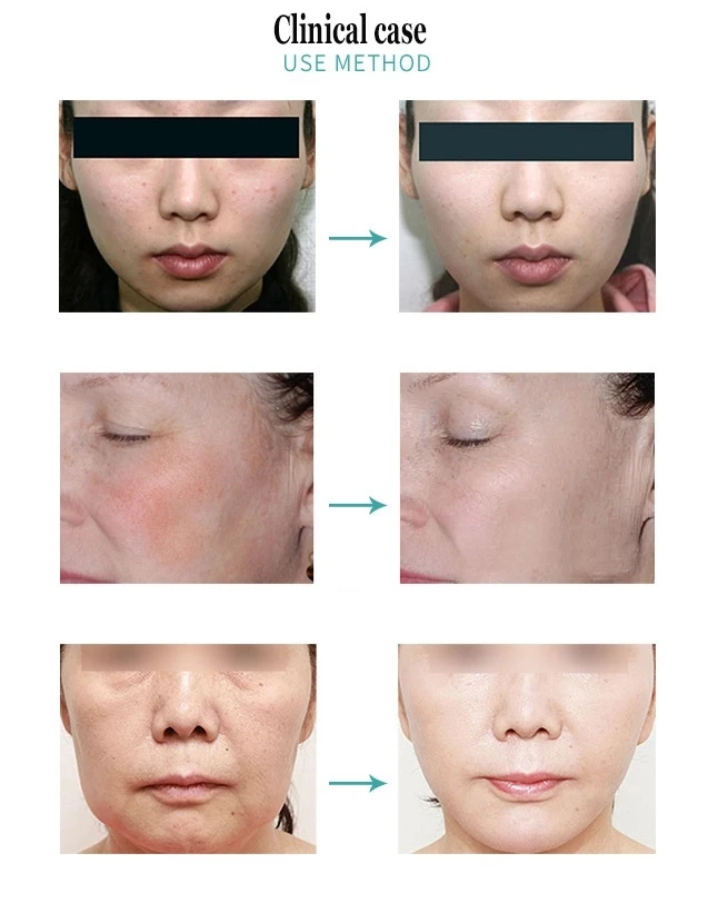 2023 professional spa 7 colors photodynamic facial pdt led light lamp 635 photon therapy skin care machine