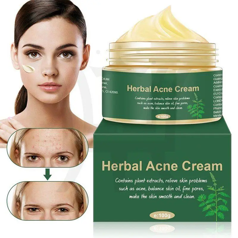 acne face cream best
