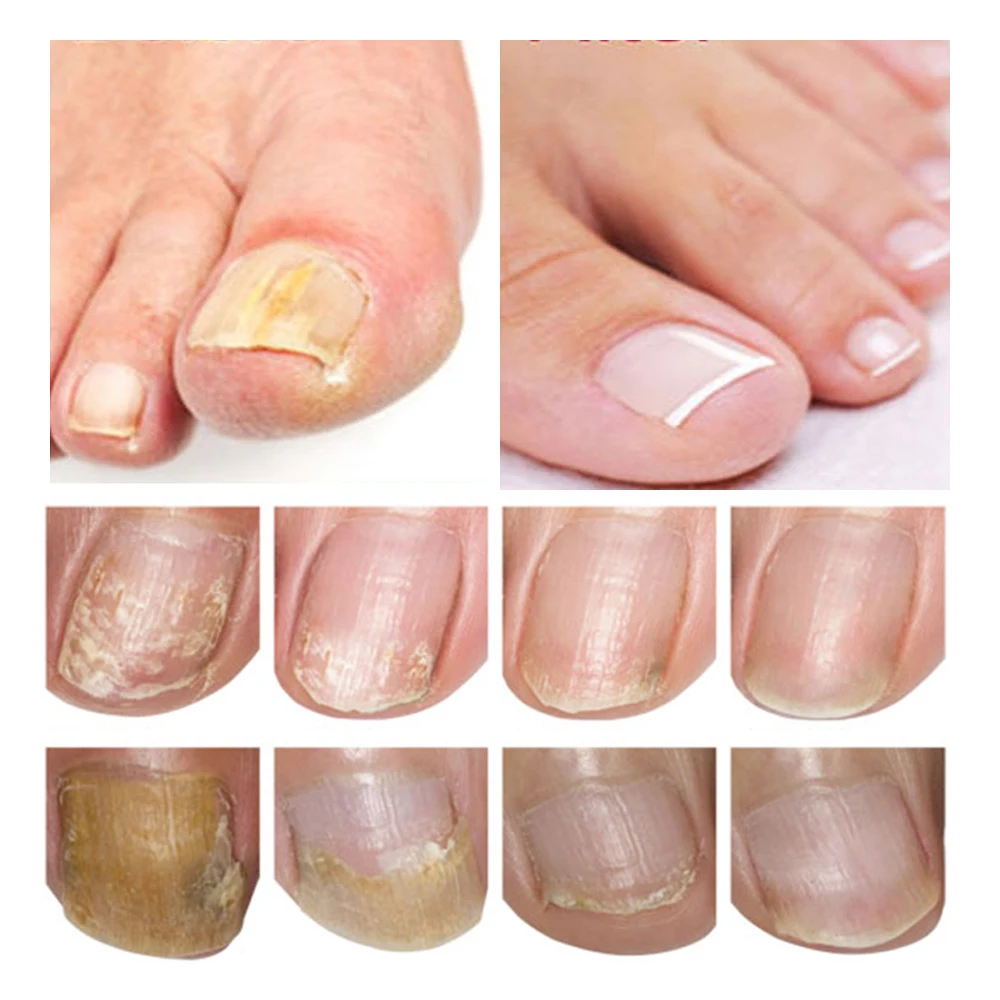 LANBENA Hot Sale Nail Essence Anti Fungus Nail Care Nourish Repair Serum details