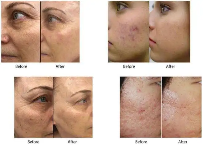 Hot Sale Portable 2-in-1 Skin Tightening Cooling Machine Fractional Beauty Device Cold Hammer ABS Material EU for Face Desktop