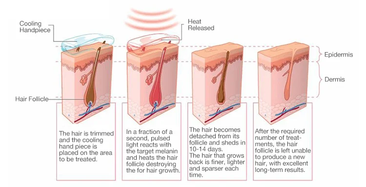 Diode Laser 755 808 1064 Diode Laser Hair Removal Machine 808nm Hair Removal Machine