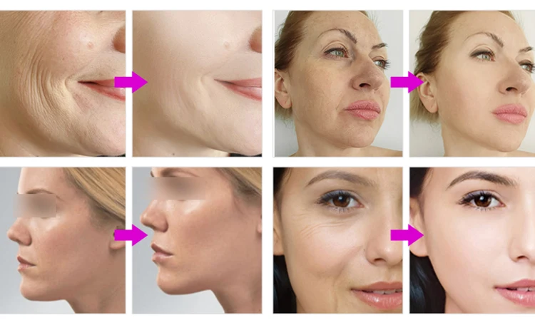 EMRF Machine Face Anti Aging Facial Muscle Stimulator Skin Lift Tightening Machine