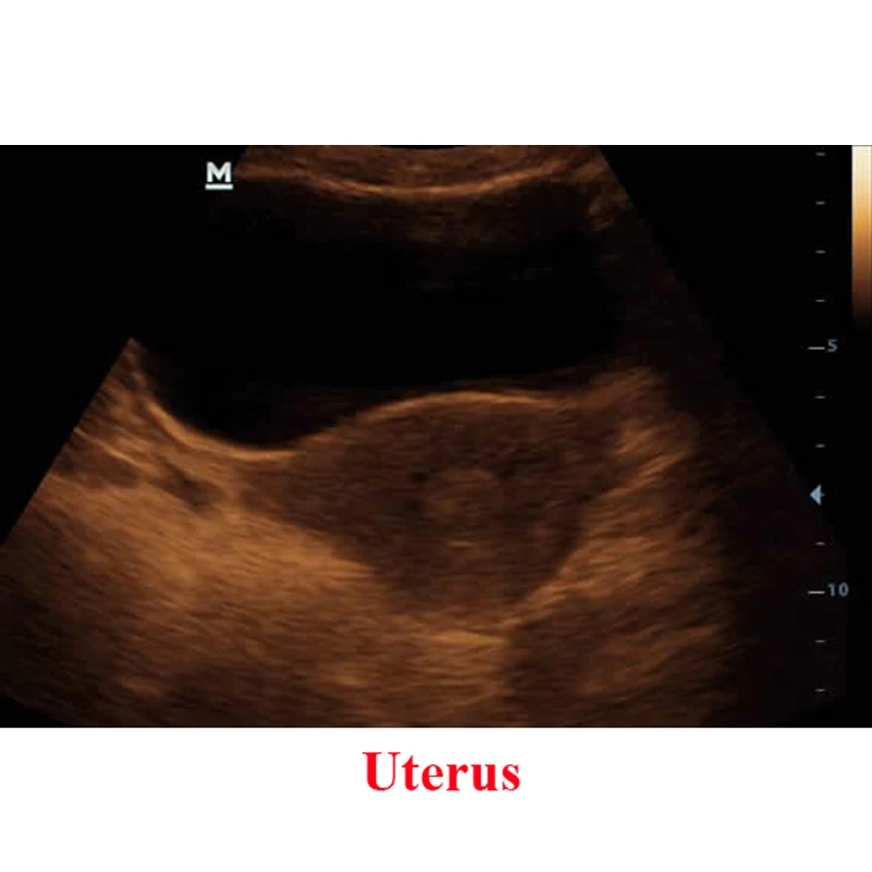 Uterus.jpg