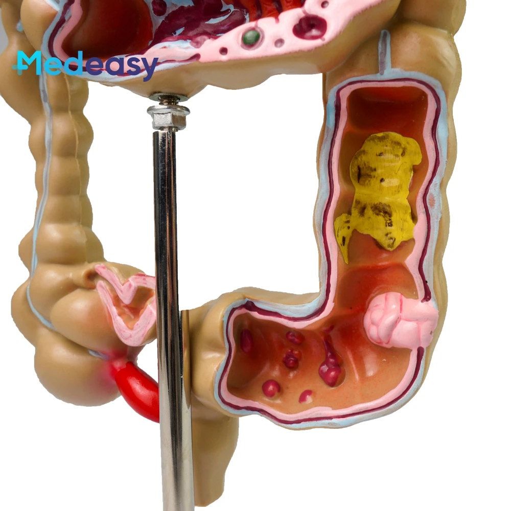The Large Inestine Model Human Colon Disease Model - Detailed Anatomical Teaching Tool