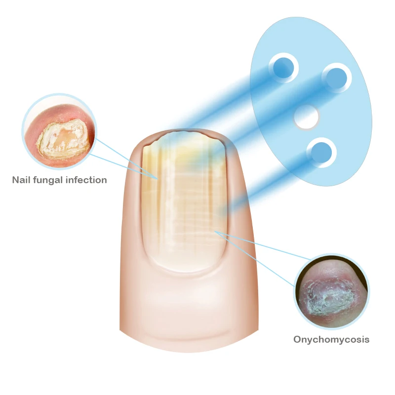 Appareil De Therapie Laser Pour Traitement Des Ongles Soin Pour Bebes De La Peau Pour Les Ongles Buy Dissolvant Fongique De Champignon D Ongle D Orteil Traitement D Onychomycose Traitement D Ongle D Anti Champignon Product On Alibaba Com