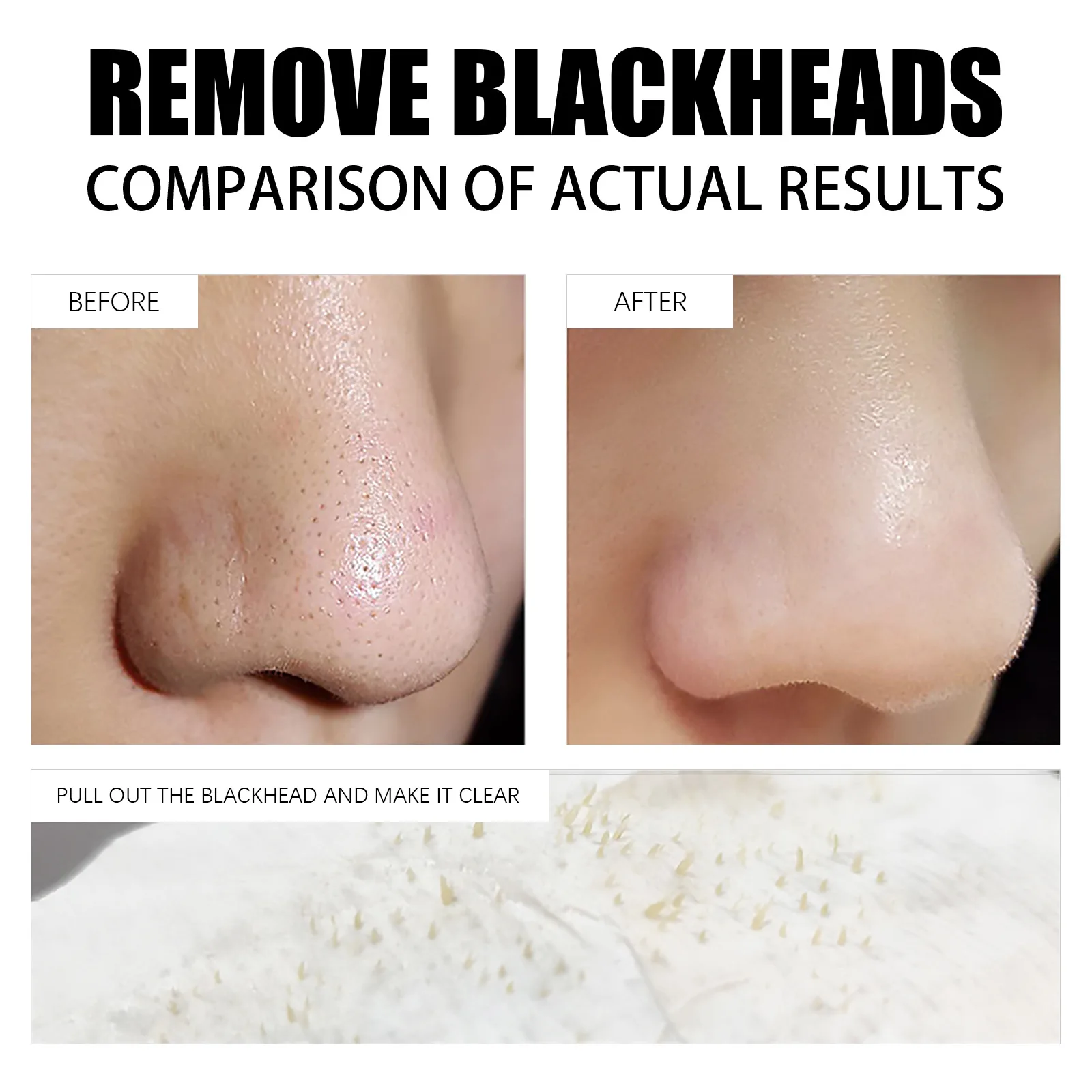 Acne] Do HYDROCOLLOID BANDAGES Work On Blackheads/papules? , 40 OFF