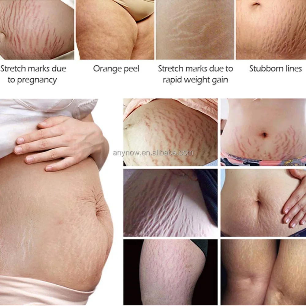  Stretch Marks Cream (8).jpg