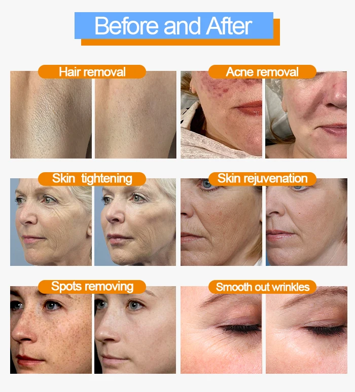 Ipl Hair Removal Machine Professional Ipl Hair Removal  Ipl Laser Pigmentation Manufacturing supplier