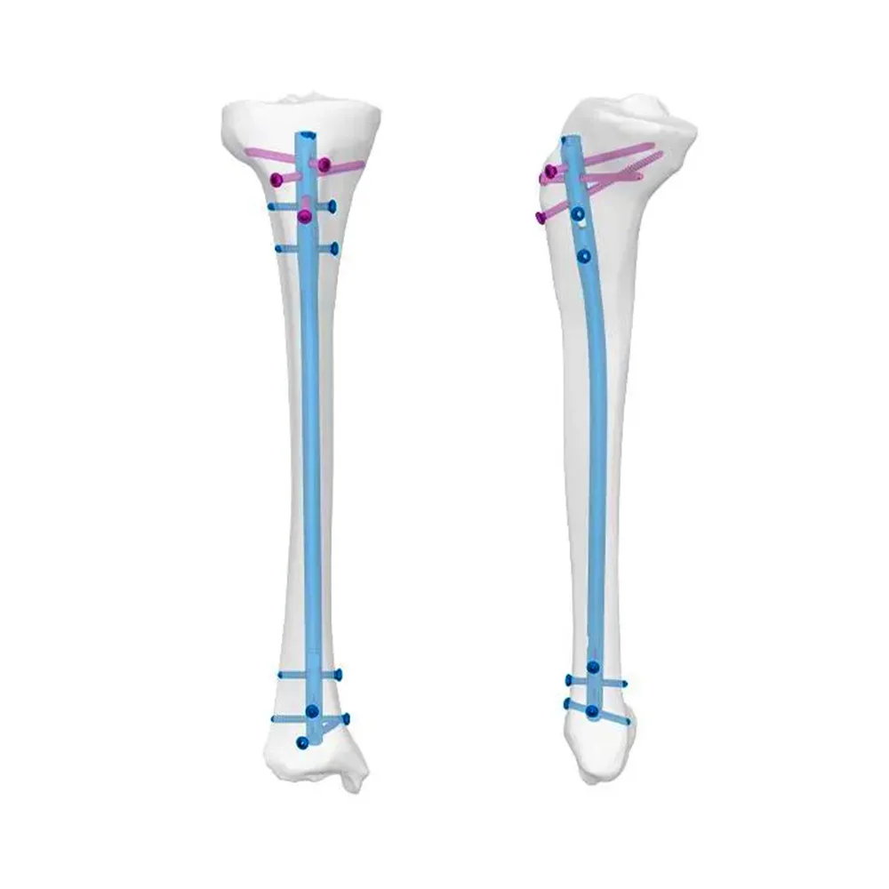 Tibia Nail