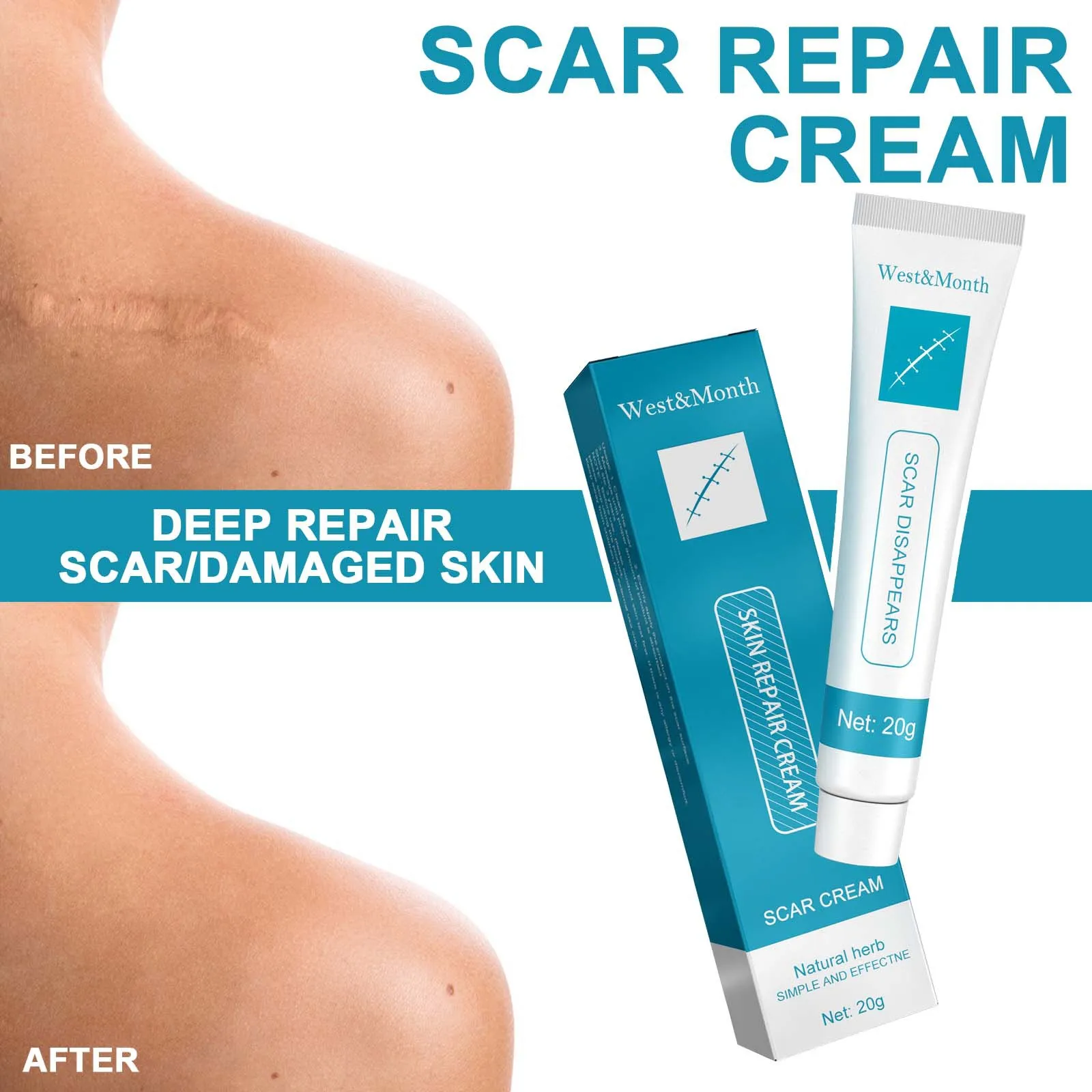 Private Label Acne Scar Removal Cream Effective Fade Old Scars ...