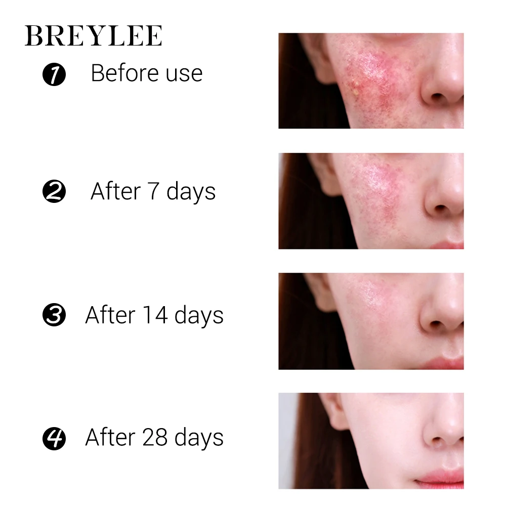 BREYLEE Private Label Tea Tree Oil Dark Spot Removing Acne Pimple Skin Repair Face Cream