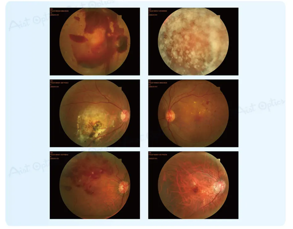 Reticam-3100 Ophthalmic Non-mydriatic Automatic Digital Retinal Fundus Camera