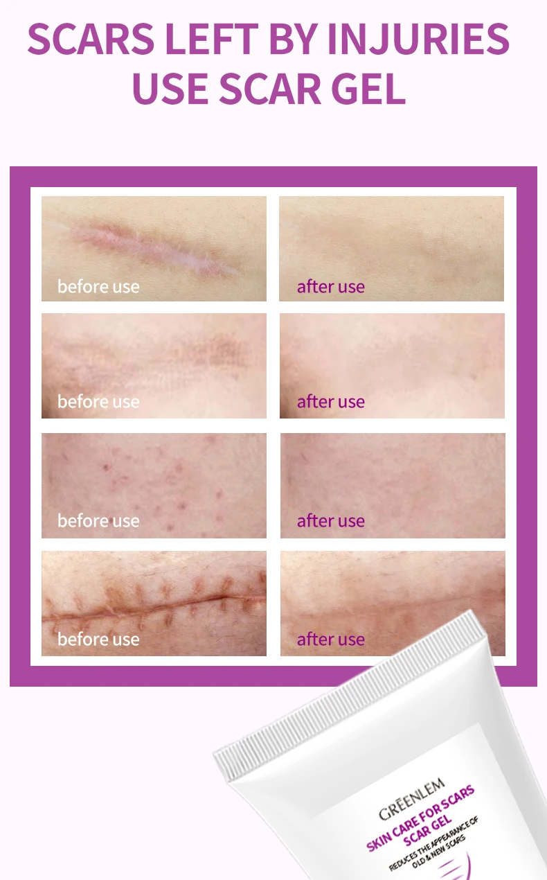 Rapid Repair Scar Stretch Mark Removal Gel Allantoin Glycerin Onion Extract-Fast Absorbing Invisible Layer for Face Body All(pic3)